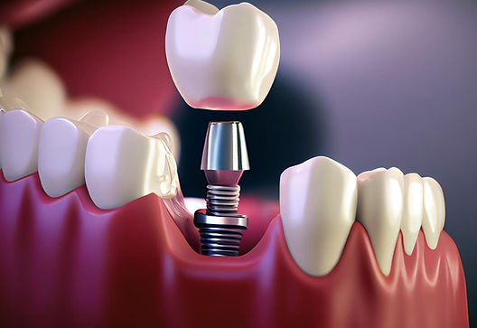Can-a-Single-Implant-Be-Placed-to-Support-Two-Adjacent-Teeth.jpg