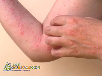 La OMS vuelve a declarar la viruela del mono como una emergencia sanitaria global.