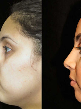 تصحيح انحراف الحاجز الأنفي: عندما يلتقي التجميل مع التنفس السليم