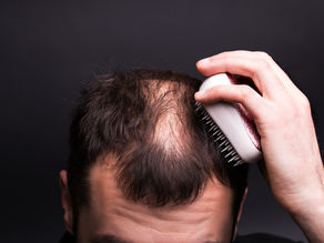 Breakthrough Treatment Offers New Hope for Alopecia Areata Patients - A New Era in Hair Loss Treatment