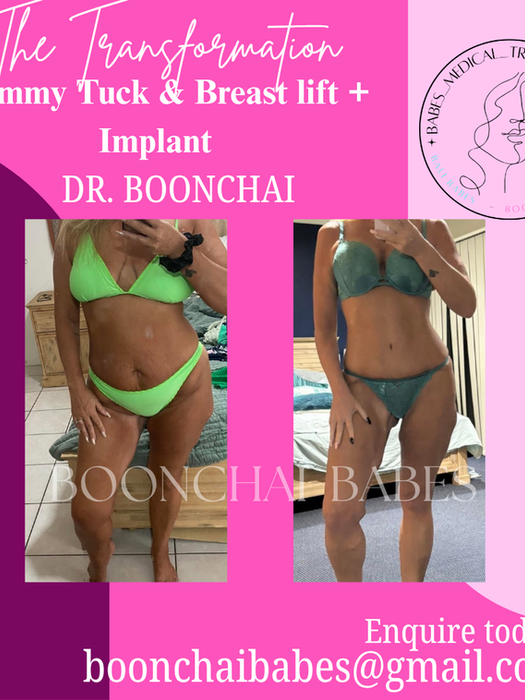 Boonchai Babes Before & After Results, Tummy Tuck & Breast Lift Doctor Boonchai
