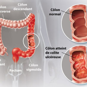 RCH : LES CAUSES POSSIBLES - Partie 2