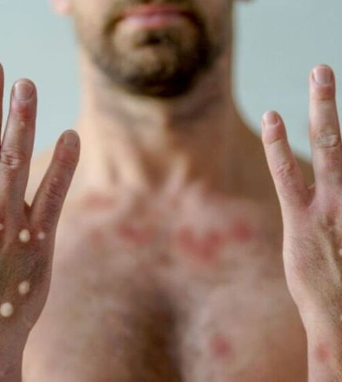 Morte de jovem é investigada como possível caso de Mpox em Itu