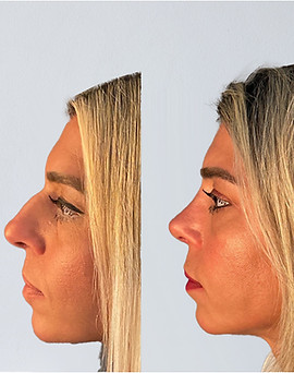 Rhinoplasty-in-istanbul-Turkey-Result-2023-4.jpg