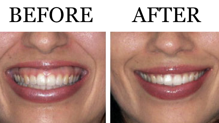 Gummy Smile Botox lifestylesolutions
