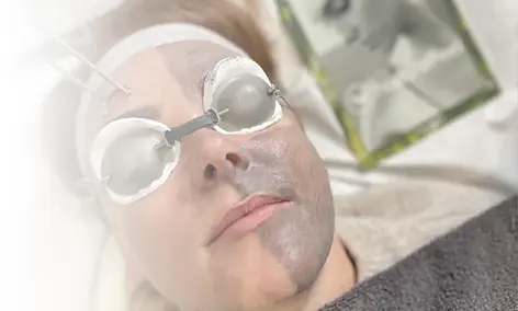 Carbon laser facial treatment in progress at Bloom & Beam Laser Studio