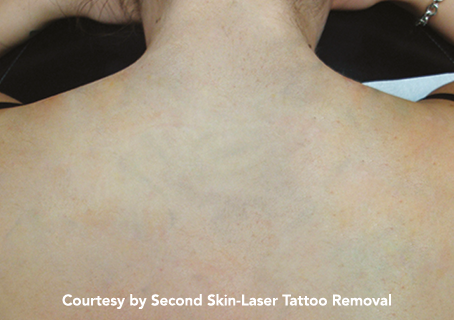 The Tattoo Fading Timeline: What to Expect Between Laser Sessions
