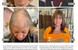 Hair loss treatment for women in Columbia Tennessee