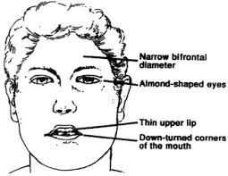 Prader-Willi Syndrome
