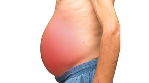 Ascites