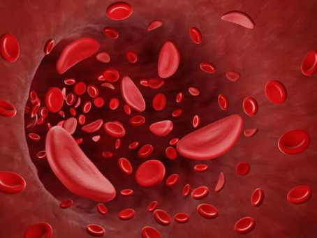 Sickle Cells Anemia