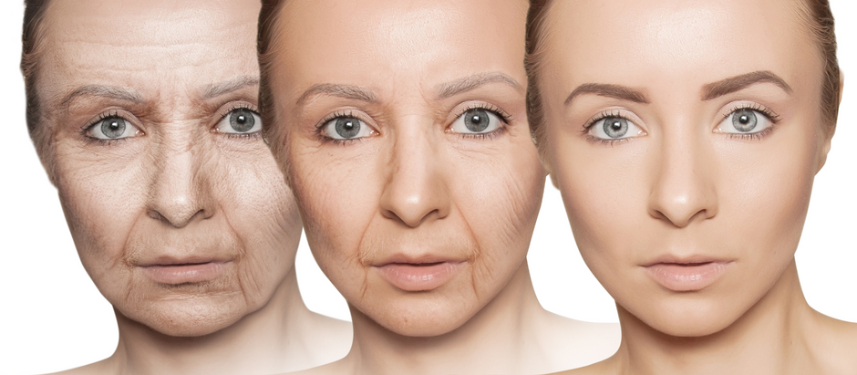 Progressive Aging from glycation