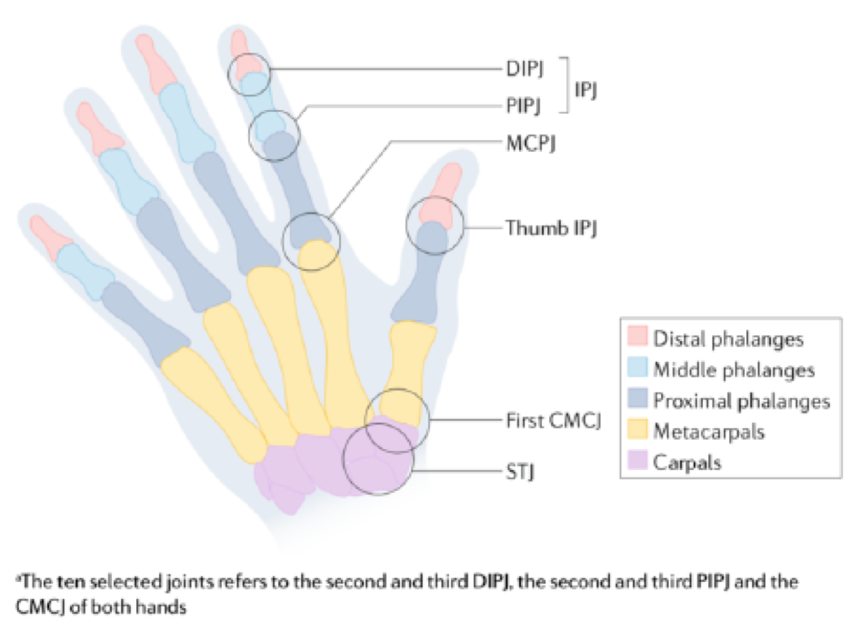 Hand Osteoarthritis