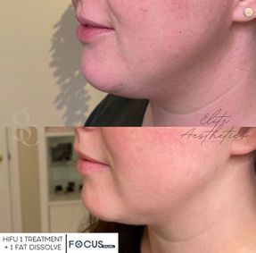 HIFU Jawline slimming oxfordshire