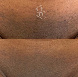 Laser Hair Removal on Darker Skin Bicester