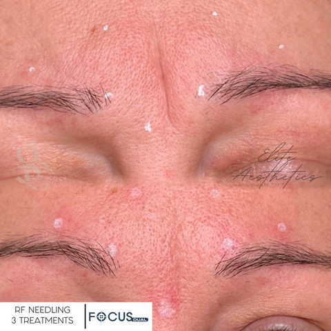 RF Needling Results