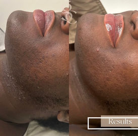Laser Hair Removal on Darker Skin Oxfordshire