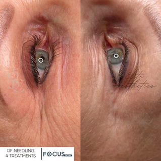 RF Needling Results