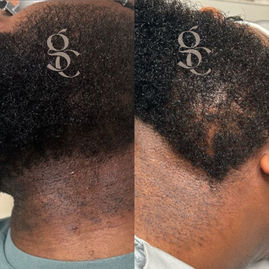 Laser Hair Removal on Black Skin Oxfordshire