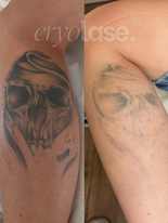 Laser tattoo removal cheshire