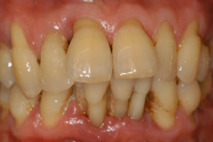 Periodontal Disease | Launch Oral Systemic Health