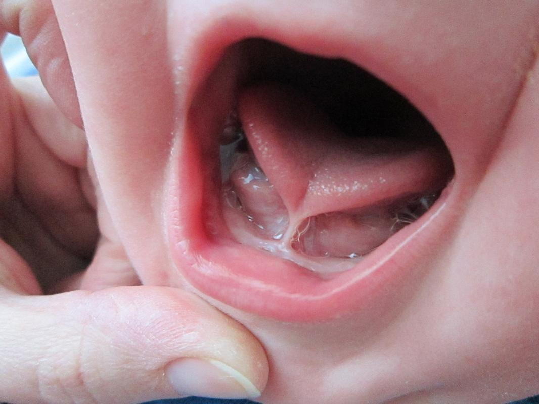 Tongue Tie | Rodriguez Speech