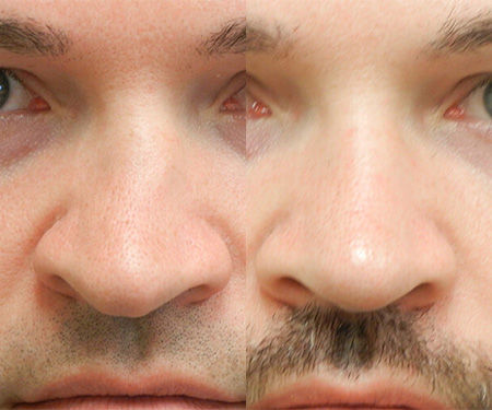 Seattle Rhinoplasty Before & After - Deviated Septum M01