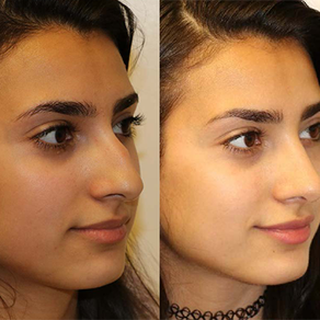 Rhinoplasty Before & After F13