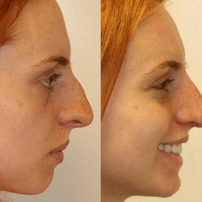 Seattle Rhinoplasty Before & After F24