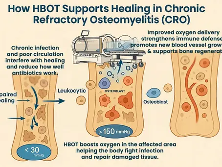 Chronic Osteomyelitis: How Hyperbaric Oxygen Therapy Supports Healing