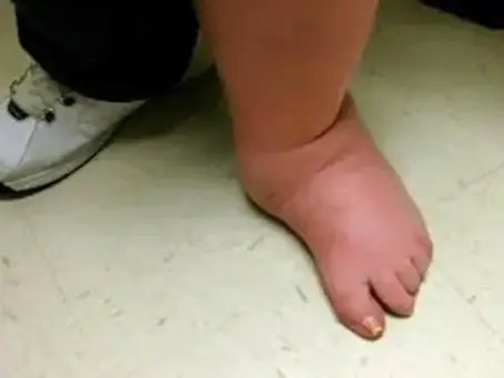 Charcot Foot and Advanced Wound Care Management
