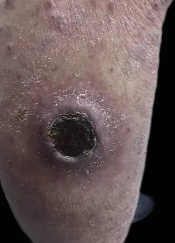 Superficial wound with a dark crust over an ulcer, indicating the healing process.