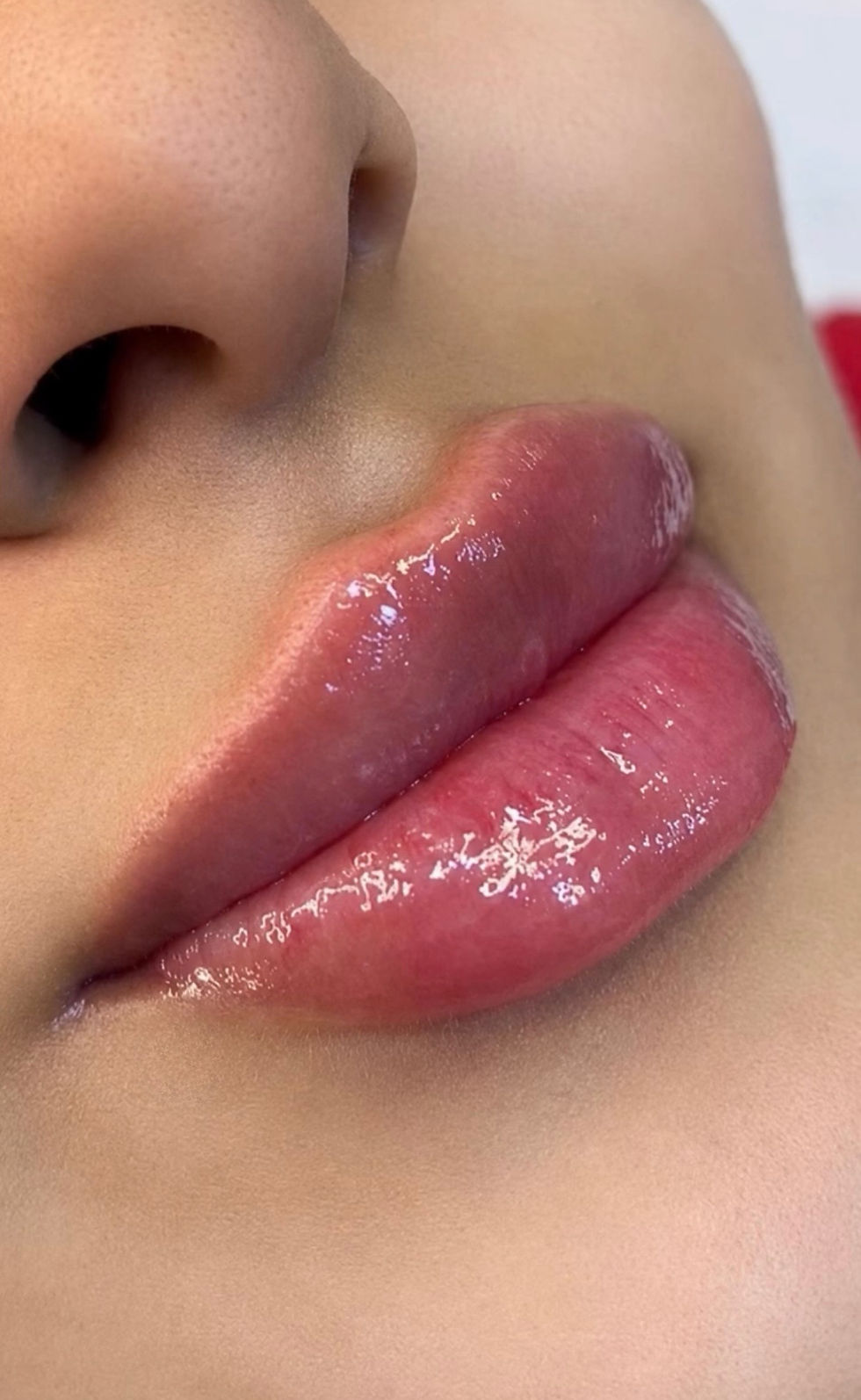 Close-up of glossy, natural-looking lip filler result