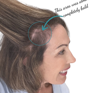 Why I Was Losing Hair in Menopause — And the Plant-Based Changes That Brought It Back