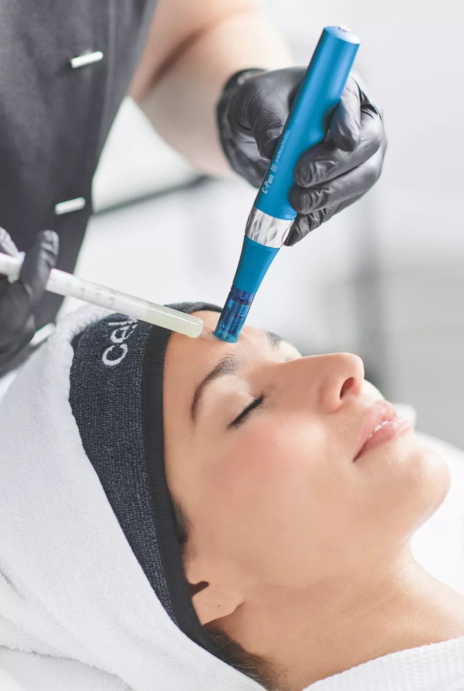 Microneedling op het voorhoofd tijdens multitechniek sessie bij Skiniek