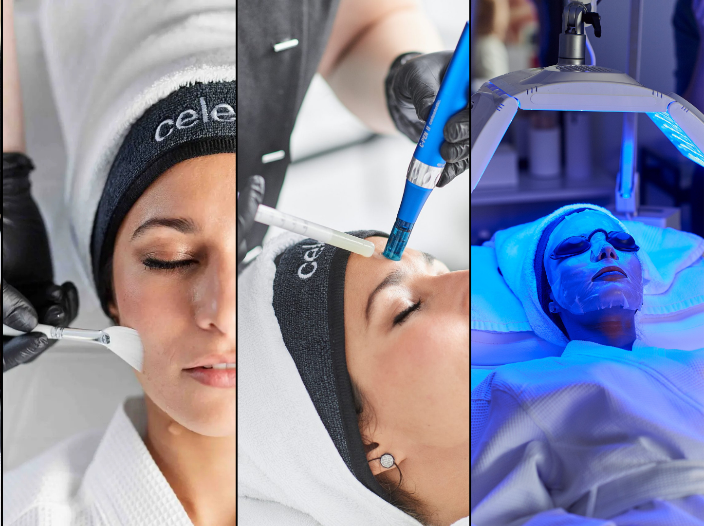 Microneedling behandeling gecombineerd met BioLED-therapie bij Skiniek