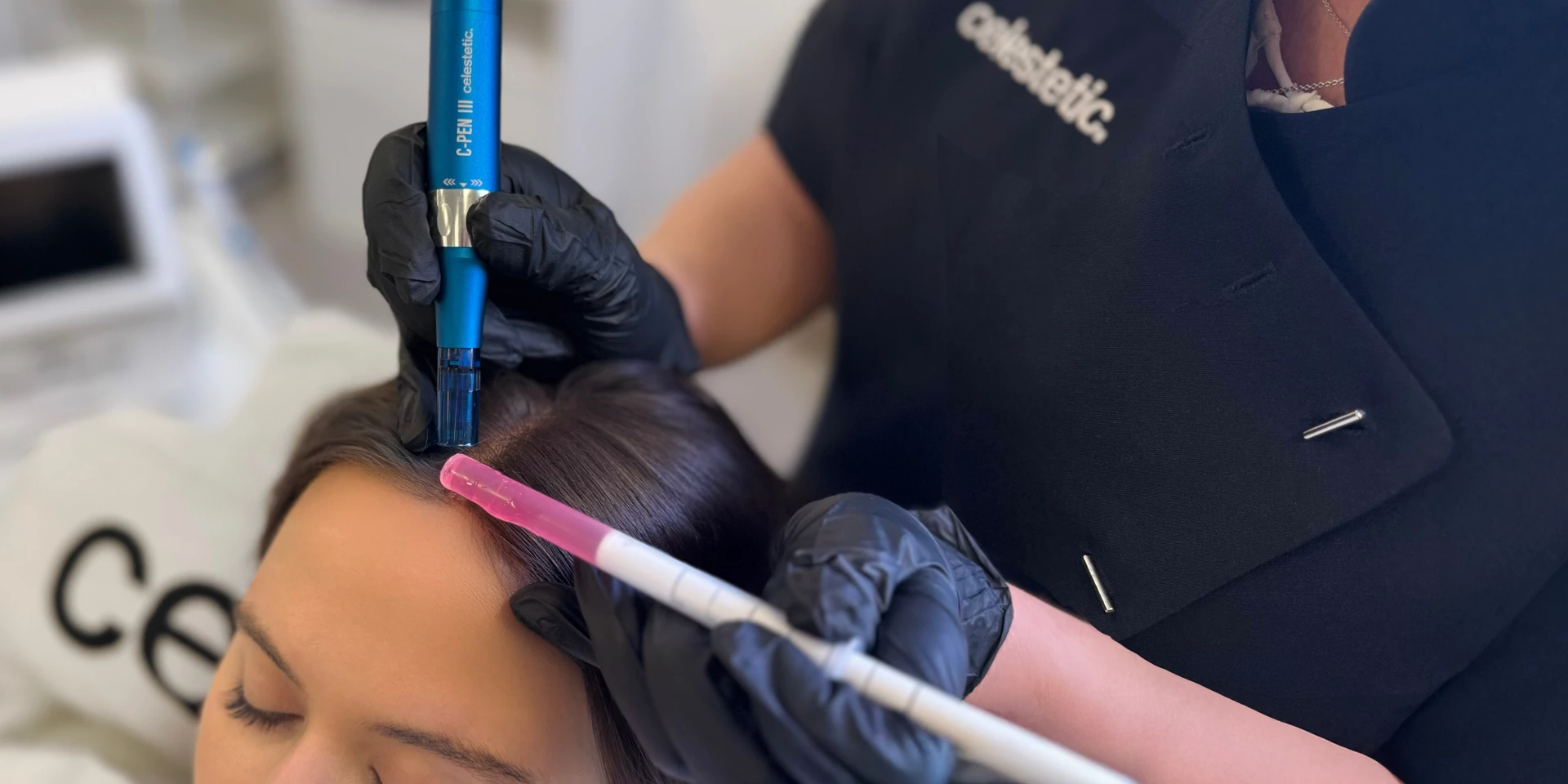Scalp microneedling met Celestetic Hair Growth serum voor haargroei