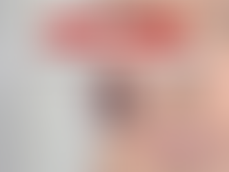 Tranexâmico+ Niacinamida vs Hidroquinona no Melasma