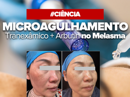 Melasma: Nova Combinação de Microagulhamento com Ácido Tranexâmico e Arbutin