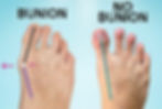 Bunion vs healthy toe splay
