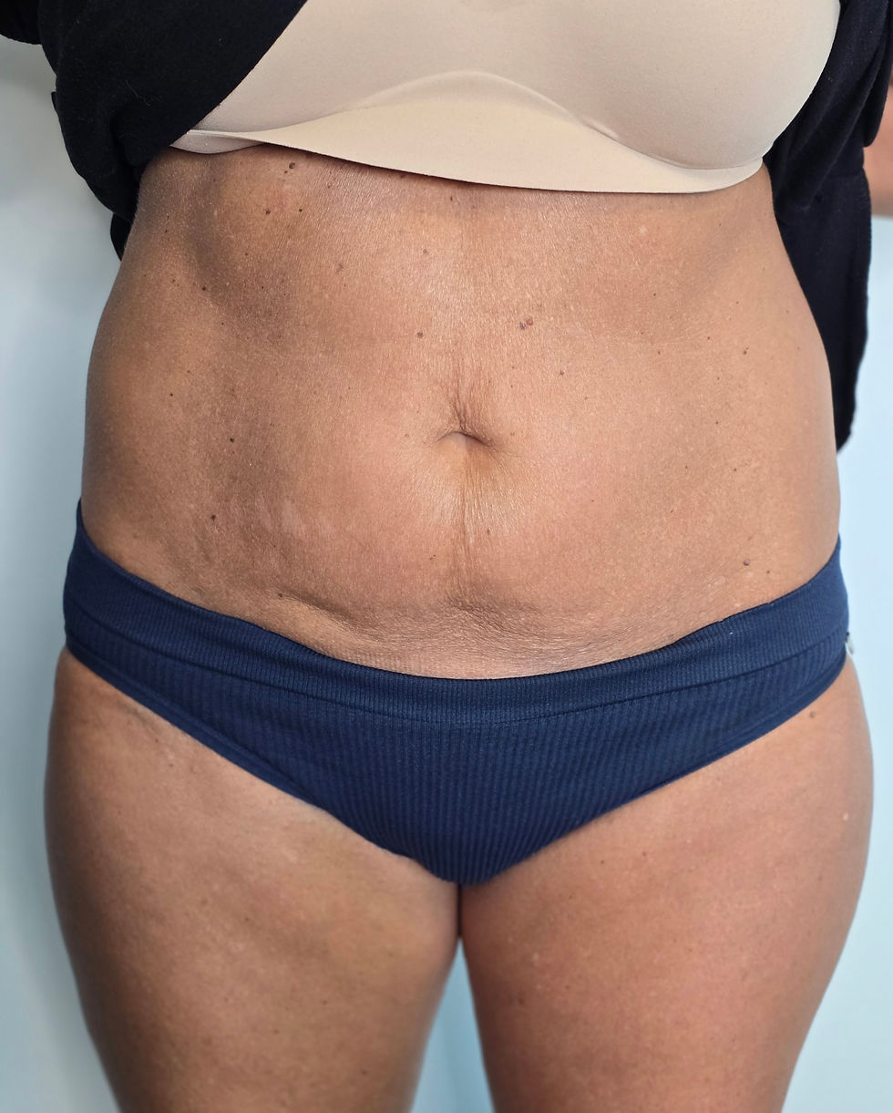 Bodytite before