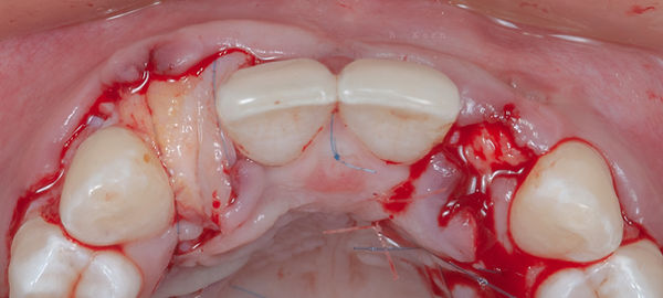 Compromized Implants .066.jpeg