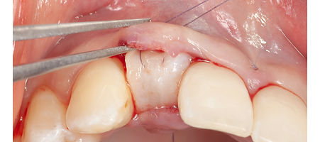 Compromized Implants .116.jpeg