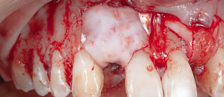 Compromized Implants .052.jpeg
