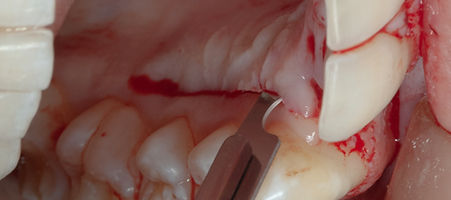 Compromized Implants .032.jpeg