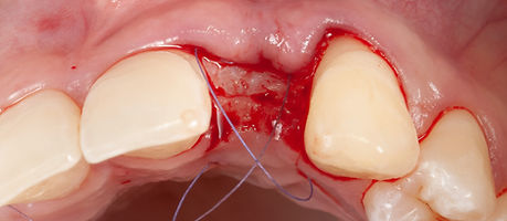 Compromized Implants .098.jpeg