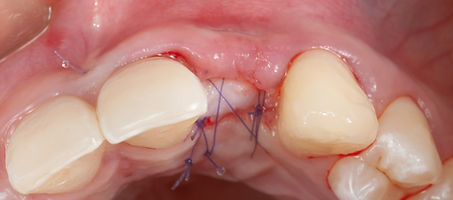 Compromized Implants .102.jpeg