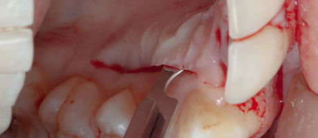 Compromized Implants .031.jpeg