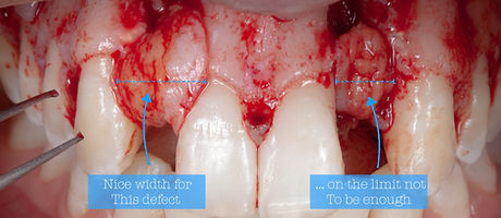 Compromized Implants .039.jpeg