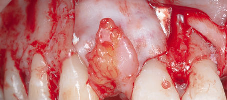 Compromized Implants .056.jpeg